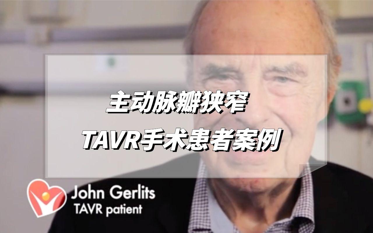 TAVR主动脉瓣狭窄患者案例